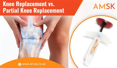 Knee Replacement vs. Partial Knee Replacement | AMSK