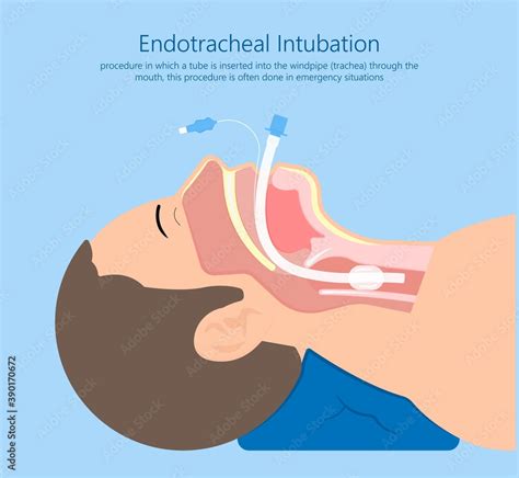 Endotracheal intubation ICU care unit COVID 19 larynx throat rescue ...