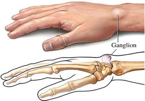 Ganglion Cyst - Causes & Management of Painful Ganglion Cysts