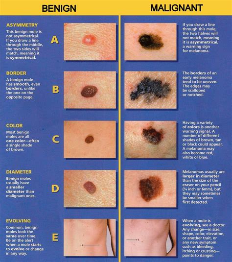 Melanoma: How do you know if a mole is dangerous? - Carenity