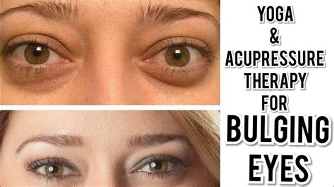 Eye Exercises & Accupressure Therapy for Bulging Eyes or protruding ...