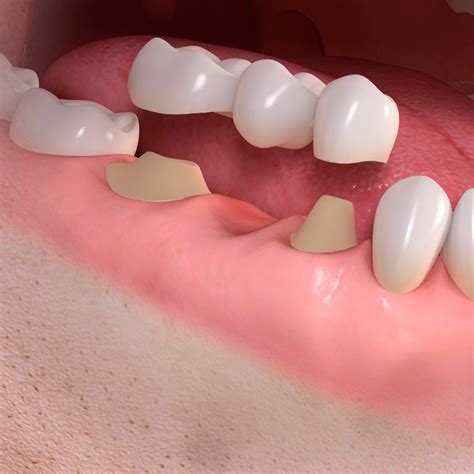 Conventional_3-unit_bridge_treatment_03 - Dr. Gallone - Specialista ...