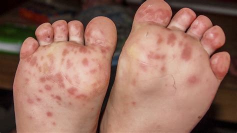 Images Of Hand Foot And Mouth Disease On Feet Deals ...