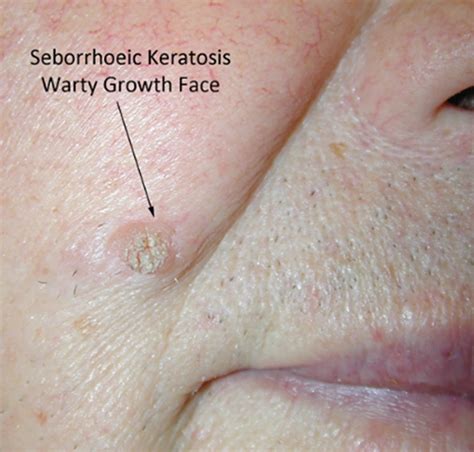 Seborrhoeic keratosis - MySkinDoctor