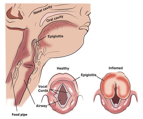 Swollen Epiglottis Treatment