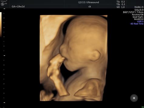 19 Week Scan Perth | Mid-trimester Ultrasound | Pregnancy Scan | Perth