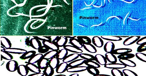 Pinworm Infections: Signs and symptoms, Causes, Diagnosis and Treatment.