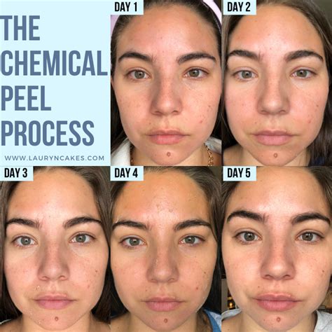 Jessner Chemical Peel: Before/After Photos of the Proven Facial ...