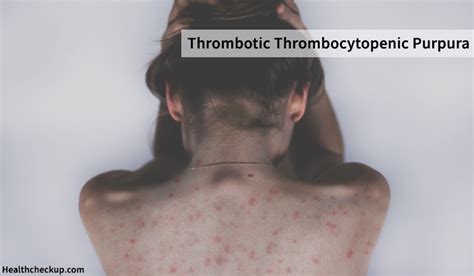 Thrombotic Thrombocytopenic Purpura Symptoms, Causes,Treatment, Life ...