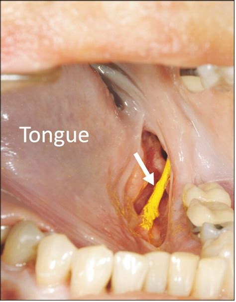 An anatomical study of the lingual nerve in the lower third molar area ...