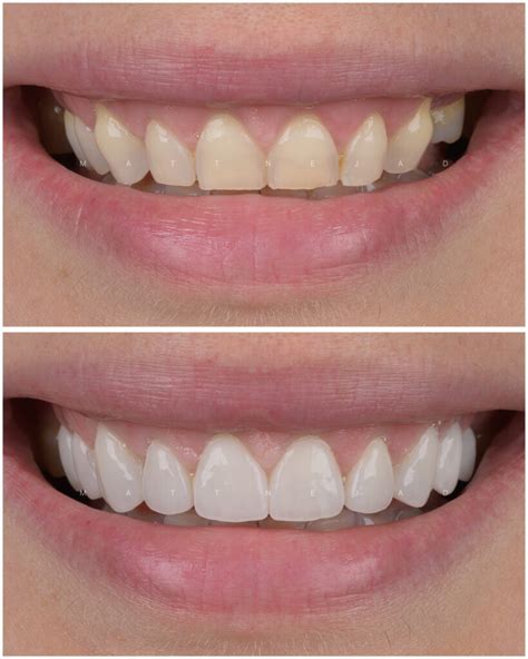 Closeup before & after #35 - 10 veneers Closeup before & after #35 - 10 ...