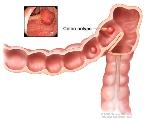 Colon Cancer Colonoscopy