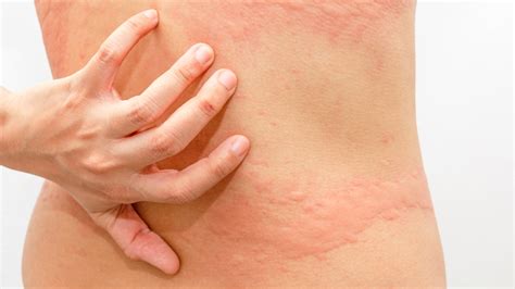 Fibromyalgia Rash: Pictures and Treatment