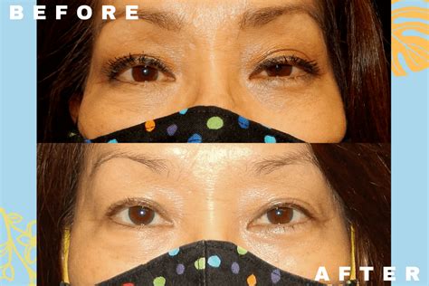 Ptosis Repair Honolulu | Eyelid Surgery Oahu | The Oculoplastics Center