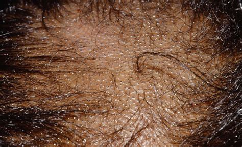 Tinea capitis scalp, causes, symptoms, diagnosis & tinea capitis treatment