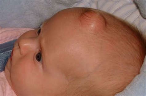 Epidermoid Cyst – Pictures, Symptoms, Causes, Treatment