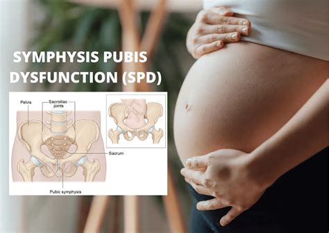 Symphysis Pubis Dysfunction (SPD) - Orchard Health Clinic - Osteopathy ...