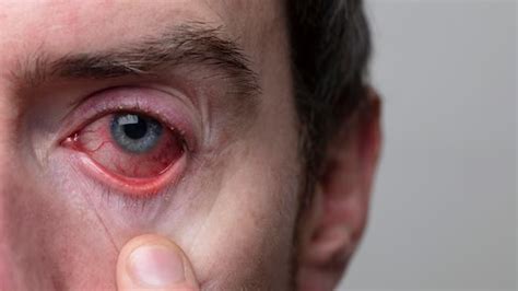 Infectious Eye Disease: Expert Explains Trachoma And How It Can Lead To ...