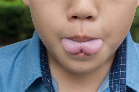 Tongue-Tie : Overview, Causes, Symptoms, Treatment - illness.com