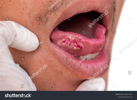 Squamous Cell Carcinoma Tongue Oral Cancer Stock Photo 2236521813 ...