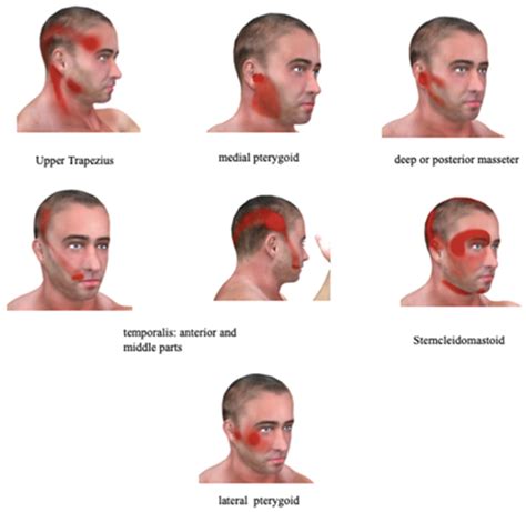 IJERPH | Free Full-Text | Chronic Facial Pain: Trigeminal Neuralgia ...