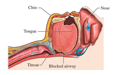 Sleep Apnea - Causes and Risk Factors | NHLBI, NIH