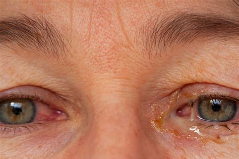 Eye Discharge: Causes, Treatment, and More | MyVision.org