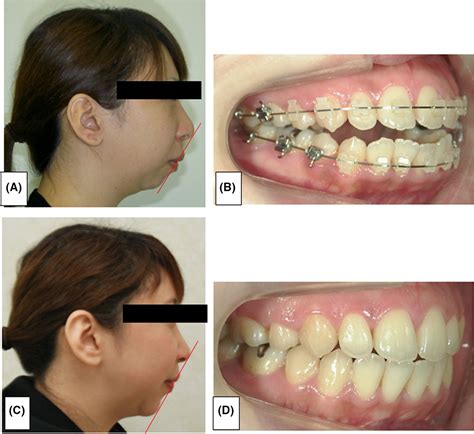 Analysis of micrognathia with obstructive sleep apnea syndrome improved ...