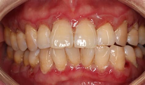 Linear Gingival Erythema