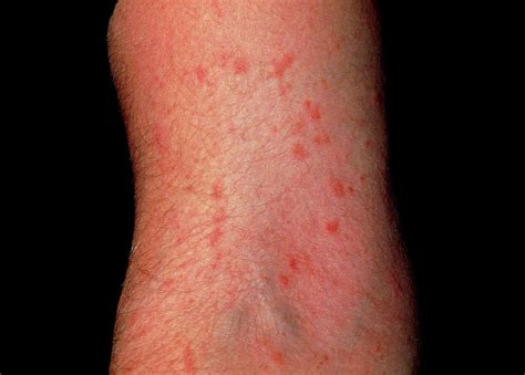 Scabies Infection On The Arm Photograph by Dr H.c.robinson / Science ...