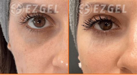 EZ Gel Natural Filler Royal Oak MI Michigan Advanced Aesthetics