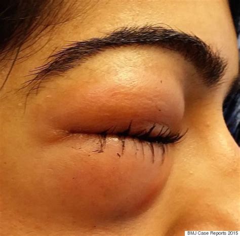 Woman Left With Severely Swollen Eye After Blowing Her Nose 'Too Hard'