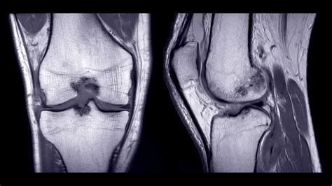 Bone Marrow Edema in the Knee: Causes, Symptoms, Treatment