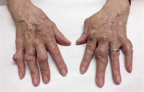 Rheumatoid Arthritis – RheumExam Atlas