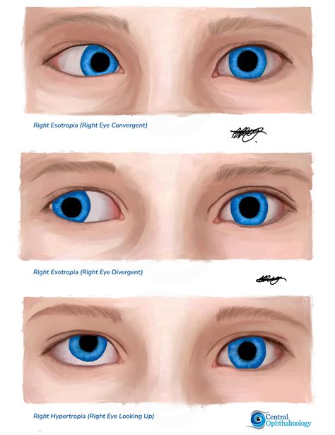 Strabismus (Squint), Sunshine Coast Squint Surgery