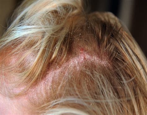 Red Spots On Scalp: Pictures, Causes, And Treatments | vlr.eng.br