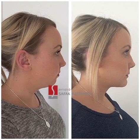 Double Chin Surgery in turkey - safakhospital