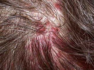 How To Get Rid Of Red Spots On Scalp | Programsrun.com