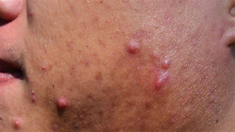 Back Acne (‘Bacne’) 101: Types, Prevention, and Treatment | Everyday Health