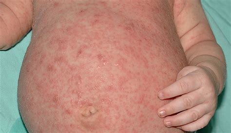 Scabies: Causes, Symptoms, Treatment & Prevention