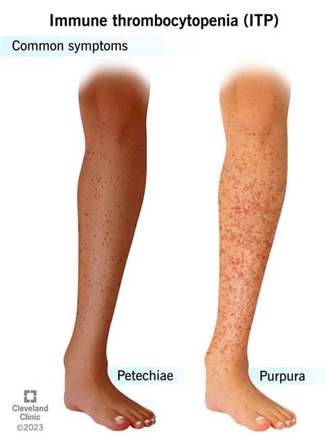 Idiopathic Thrombocytopenic Purpura