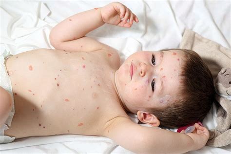 Scabies in Toddlers- Causes, Symptoms, Treatment you should be aware ...