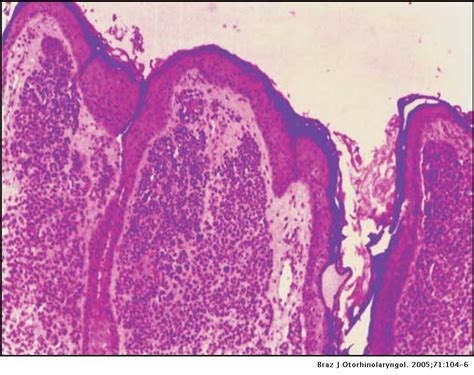 Intradermal melanocytic nevus of the external auditory canal ...