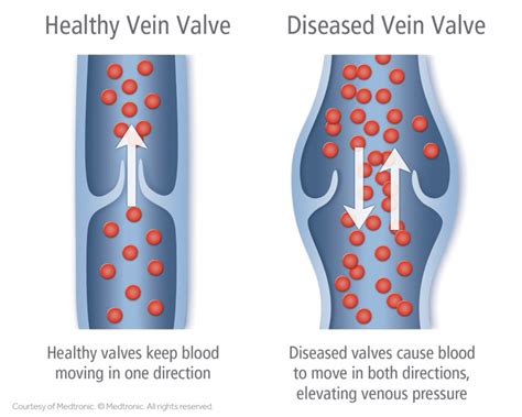 Venous Ulcer Treatment Hartford ~ Vanishing Veins | Venous Stasis ...