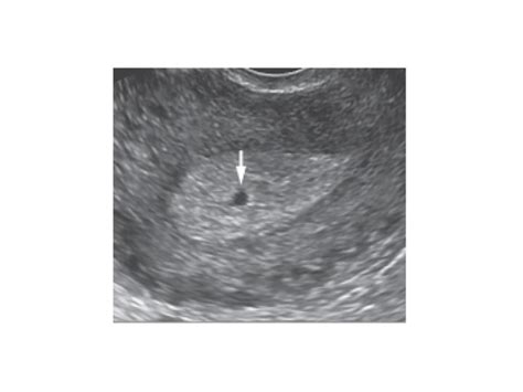 Early pregnancy ultrasound -- Normal pregnancy