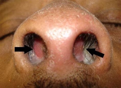 Acute nasal injury | The BMJ