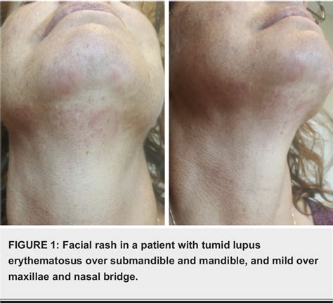 Figure 1 from Tumid Lupus Erythematosus and Systemic Lupus ...