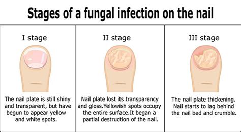 Black Toenail Fungus: Causes, Home Remedies, Treatments And More