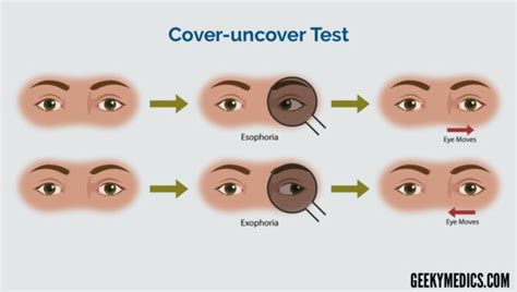 Strabismus | Exotropia - Esotropia | Cover test | Geeky Medics