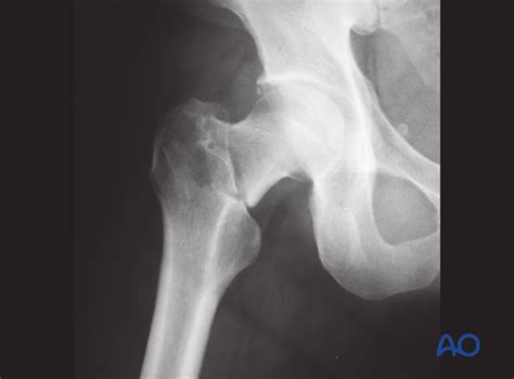 Complications and technical failures in femoral neck fracture management